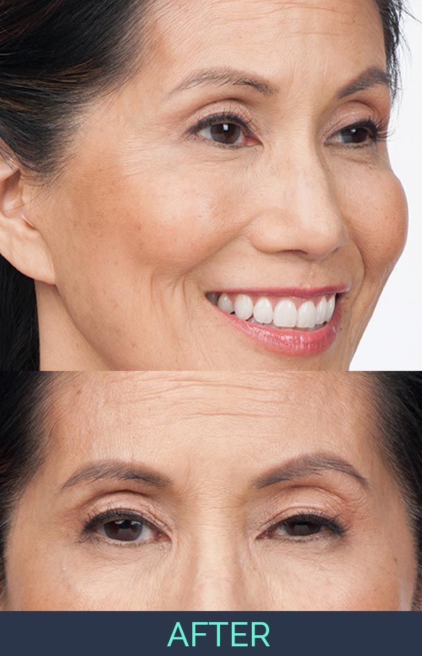 Botox Med Spa in Asheville NC Cosmetic Injectables by Board Certified MD