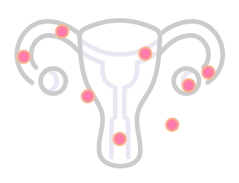 Ectopic Pregnancy How To Reduce Your Risk