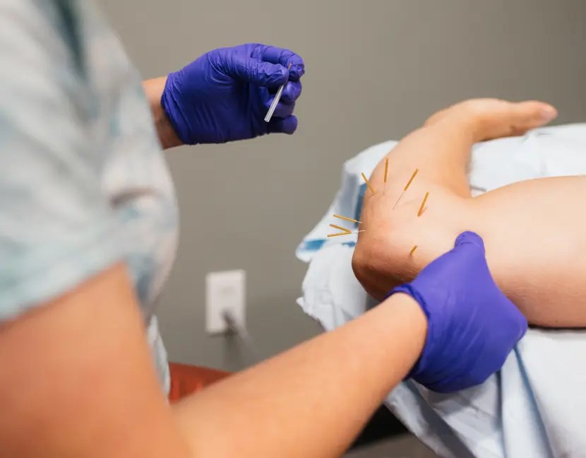 Dry Needling Services Move Smart