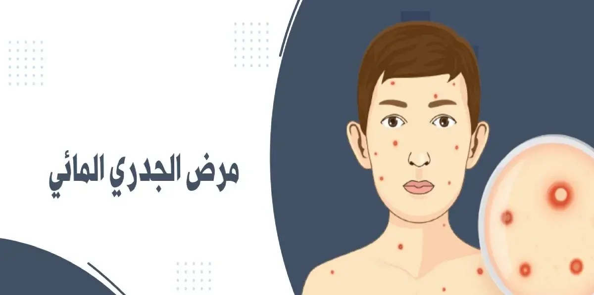 متى يكون الجدري معدي