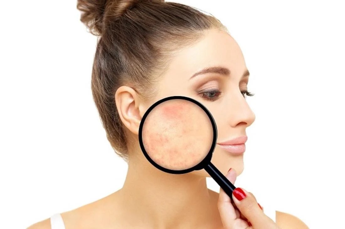 تجربتي مع قطع الندبات