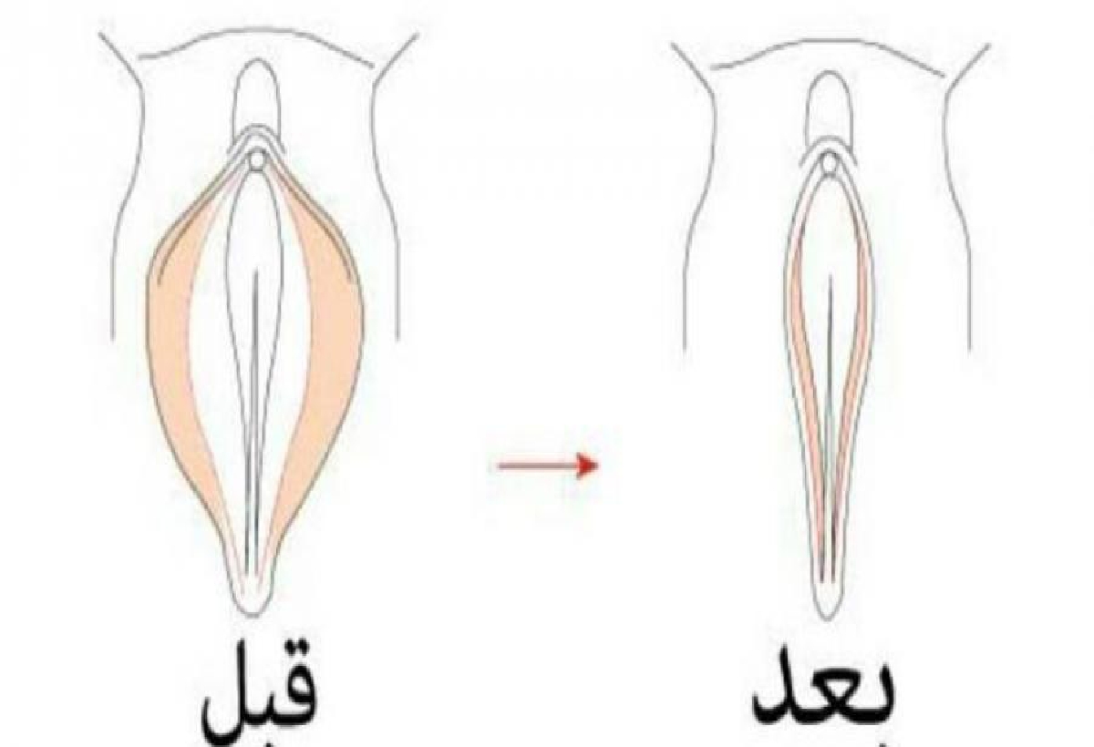 فوائد تضييق المهبل