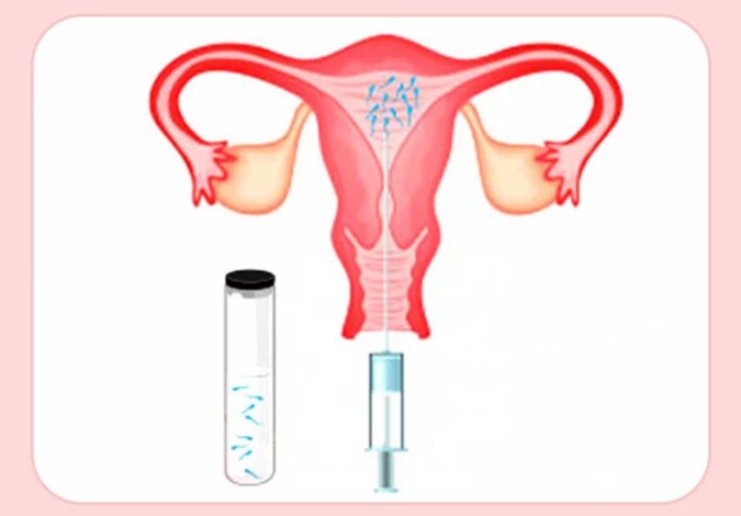 مين عملت حقن داخل الرحم وحملت