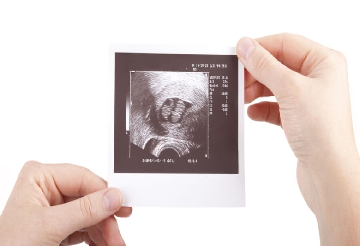 متى يظهر التوأم في السونار