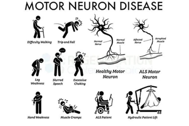 MOTOR NEURONE DISORDER (MND) Mittal Physiotherapy and Aesthatic Clinic