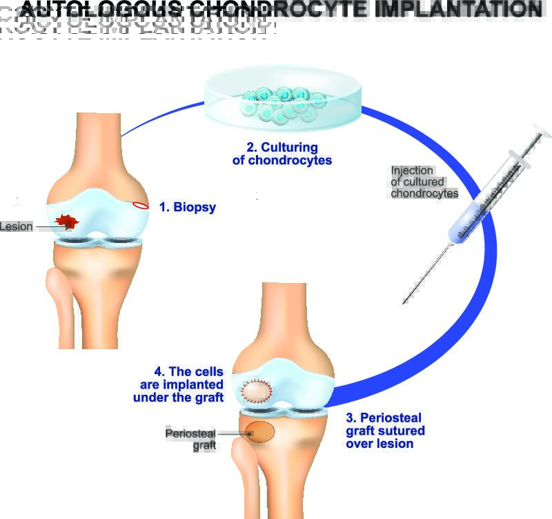 Cartilage Lesions Knee Specialist in Bristol Hywel Davies