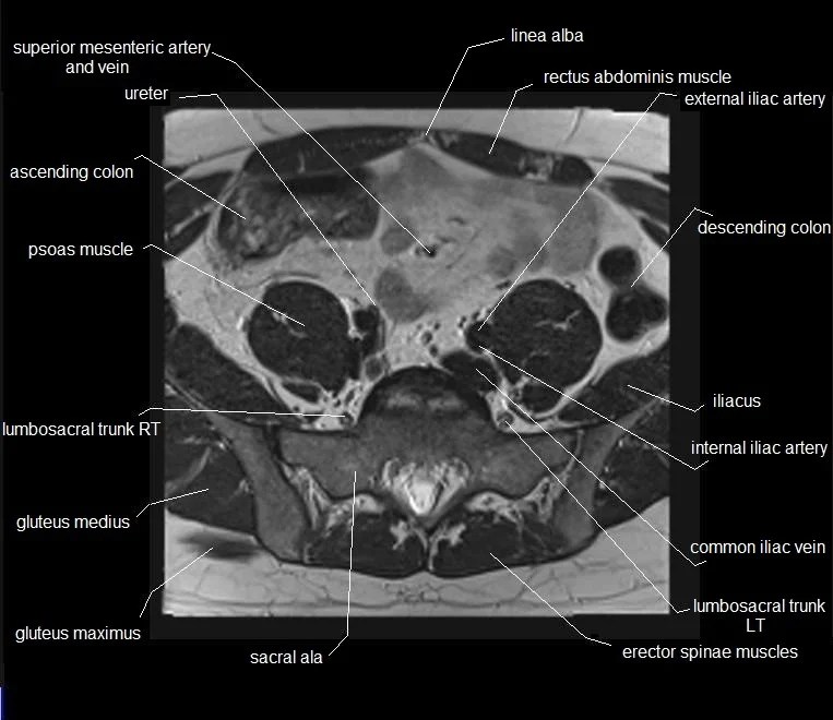 MRI pelvis Anatomy Free Male Pelvis Axial Anatomy