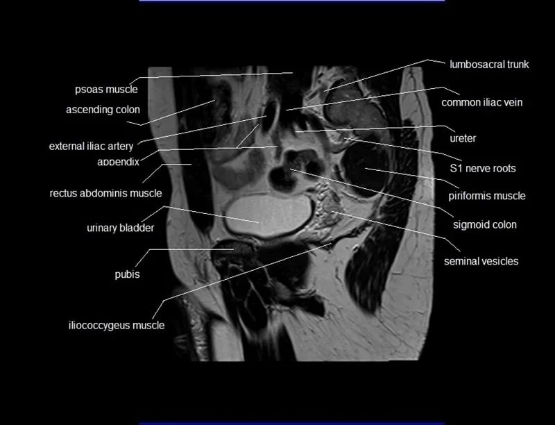MRI Male Pelvis Anatomy Free Male Pelvis Sagittal Anatomy