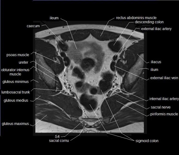 MRI pelvis Anatomy Free Male Pelvis Axial Anatomy