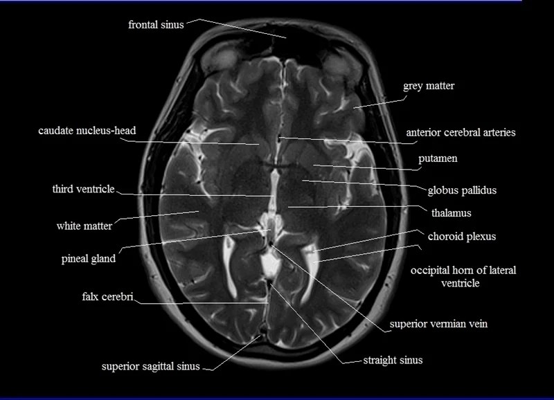 MRI anatomy Free MRI Axial Brain Anatomy