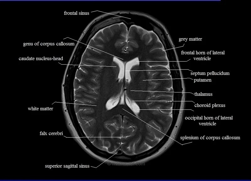 MRI anatomy Free MRI Axial Brain Anatomy