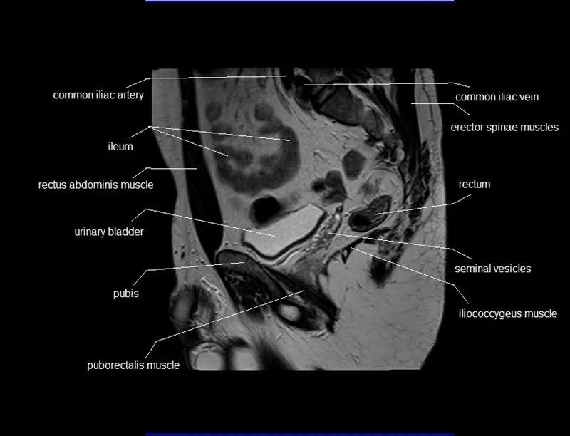 MRI Male Pelvis Anatomy Free Male Pelvis Sagittal Anatomy