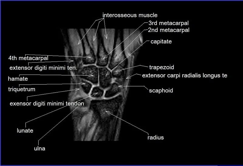 MRI Wrist Coronal Anatomy Wrist tendon and ligaments Cross sectional