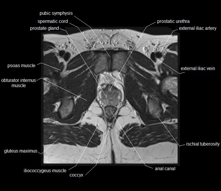 MRI pelvis Anatomy Free Male Pelvis Axial Anatomy
