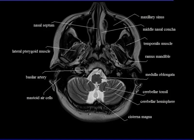 MRI anatomy Free MRI Axial Brain Anatomy