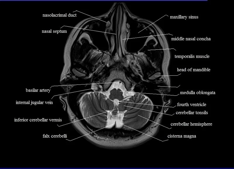 MRI anatomy Free MRI Axial Brain Anatomy