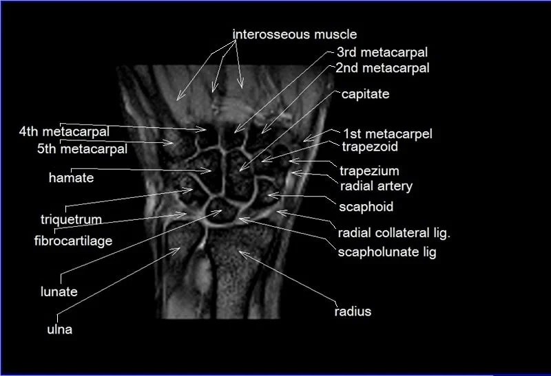 MRI Wrist Coronal Anatomy Wrist tendon and ligaments Cross sectional
