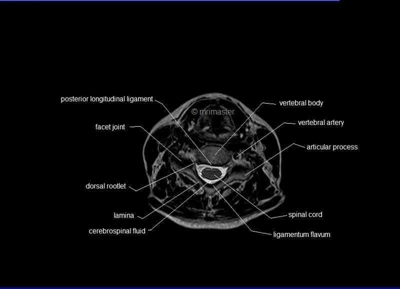 MRI Spine Anatomy Free MRI Axial Cervical Spine Anatomy