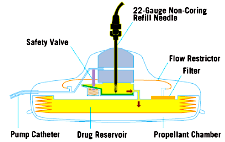 MR Safety infusion pumps Questions and Answers in MRI