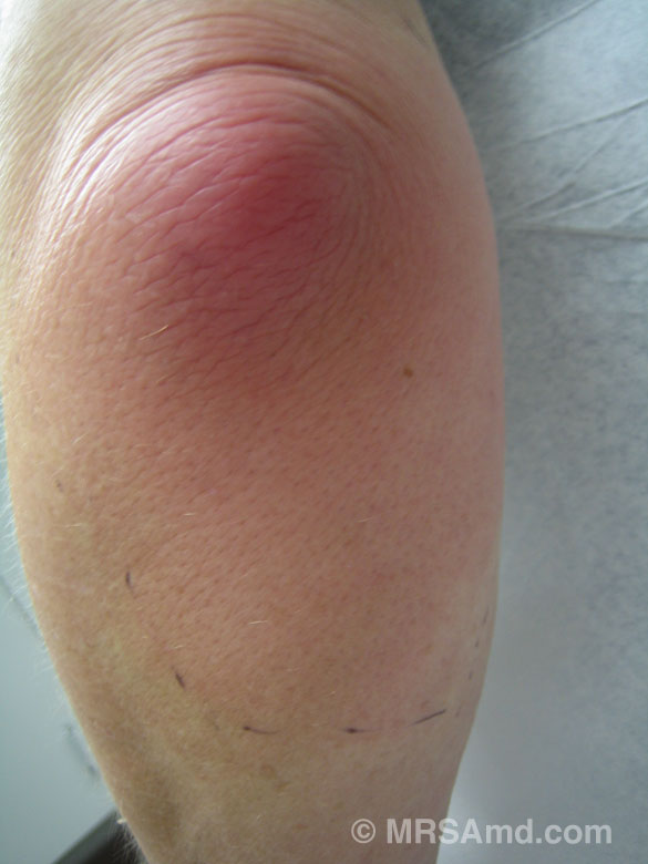 What Would Cause A Lump On My Elbow at Clayton Carpenter blog