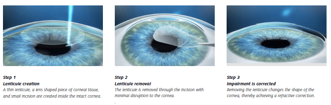 Laser Eye Surgery in UK East & UK West Eye Correction Centre