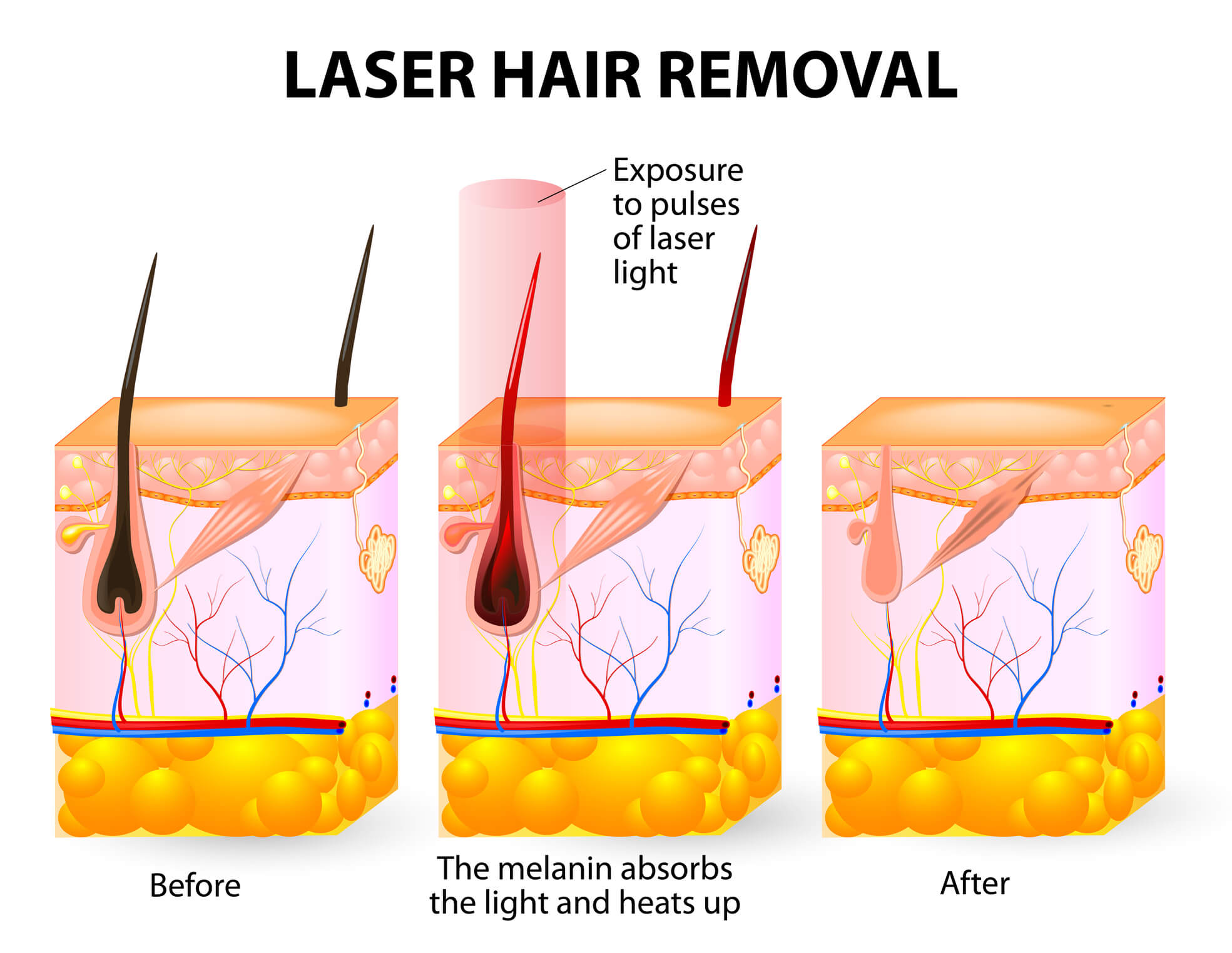 Laser Hair Removal Beckley WV Mountain State Cosmetic Surgery