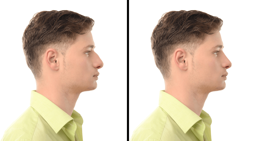 How Does Rhinoplasty Work? Mountain State Cosmetic Surgery
