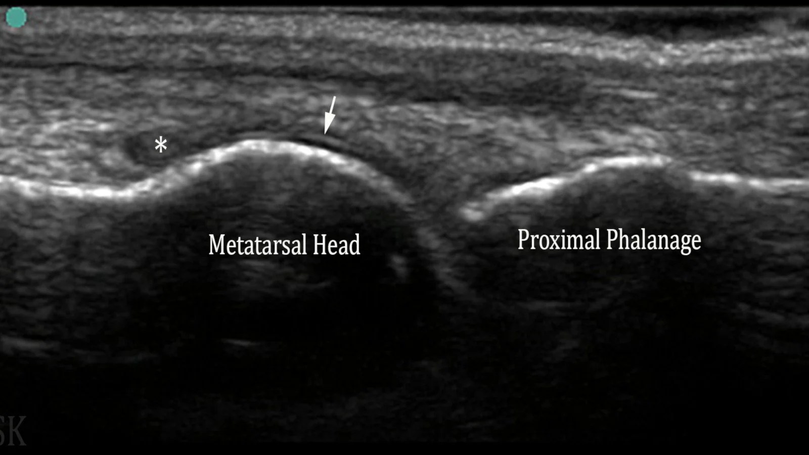 Gout Book Of MSK Ultrasound