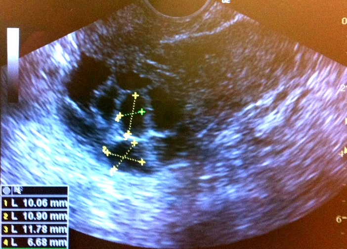 That’s my left ovary, and all of those dark spots are follicles. This