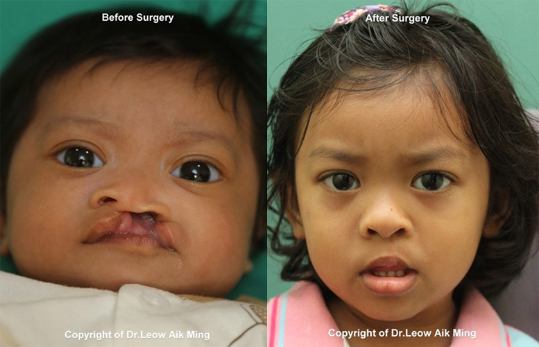 Cleft Lip and Palate MSPRS