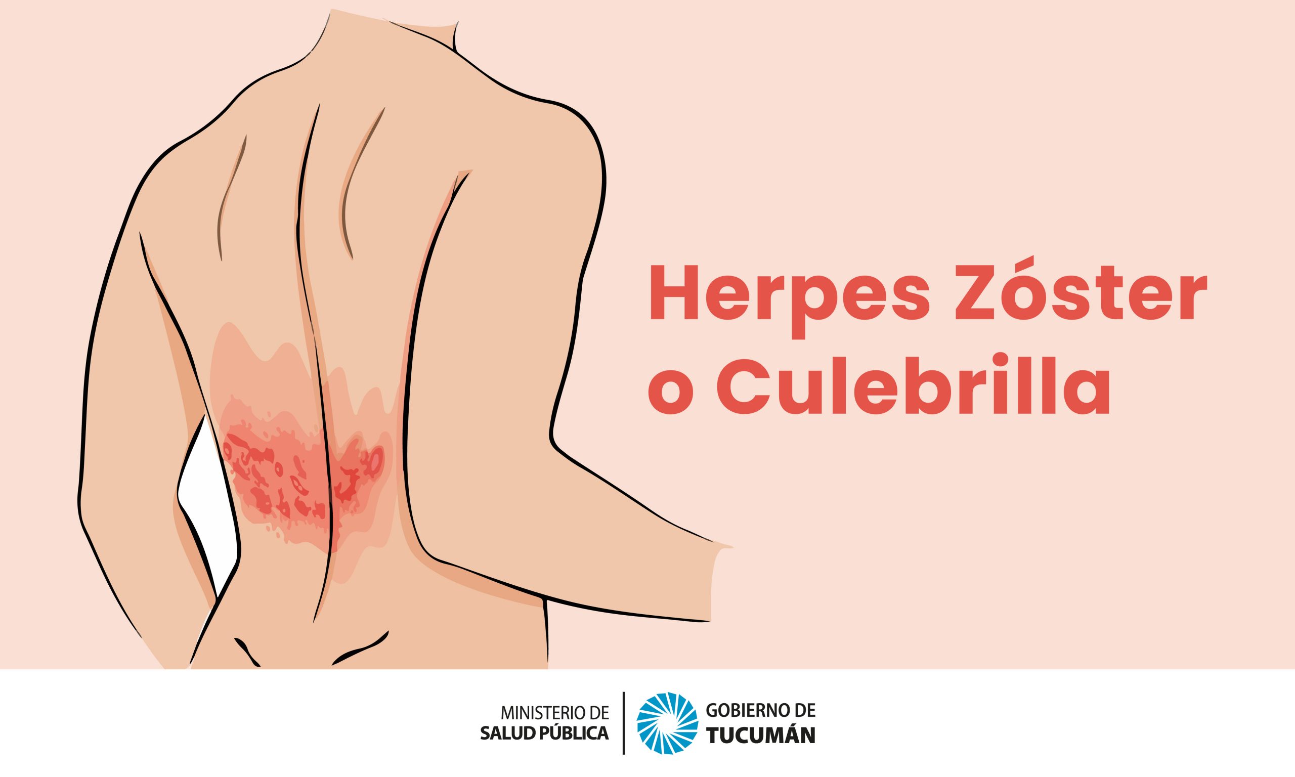 Herpes Zoster o Culebrilla por qué se produce y cómo se trata Ministerio de Salud Pública de