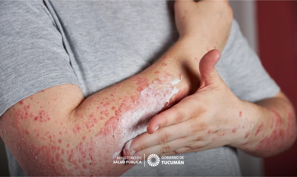 Psoriasis importancia de un diagnóstico y tratamiento oportuno Ministerio de Salud Pública de