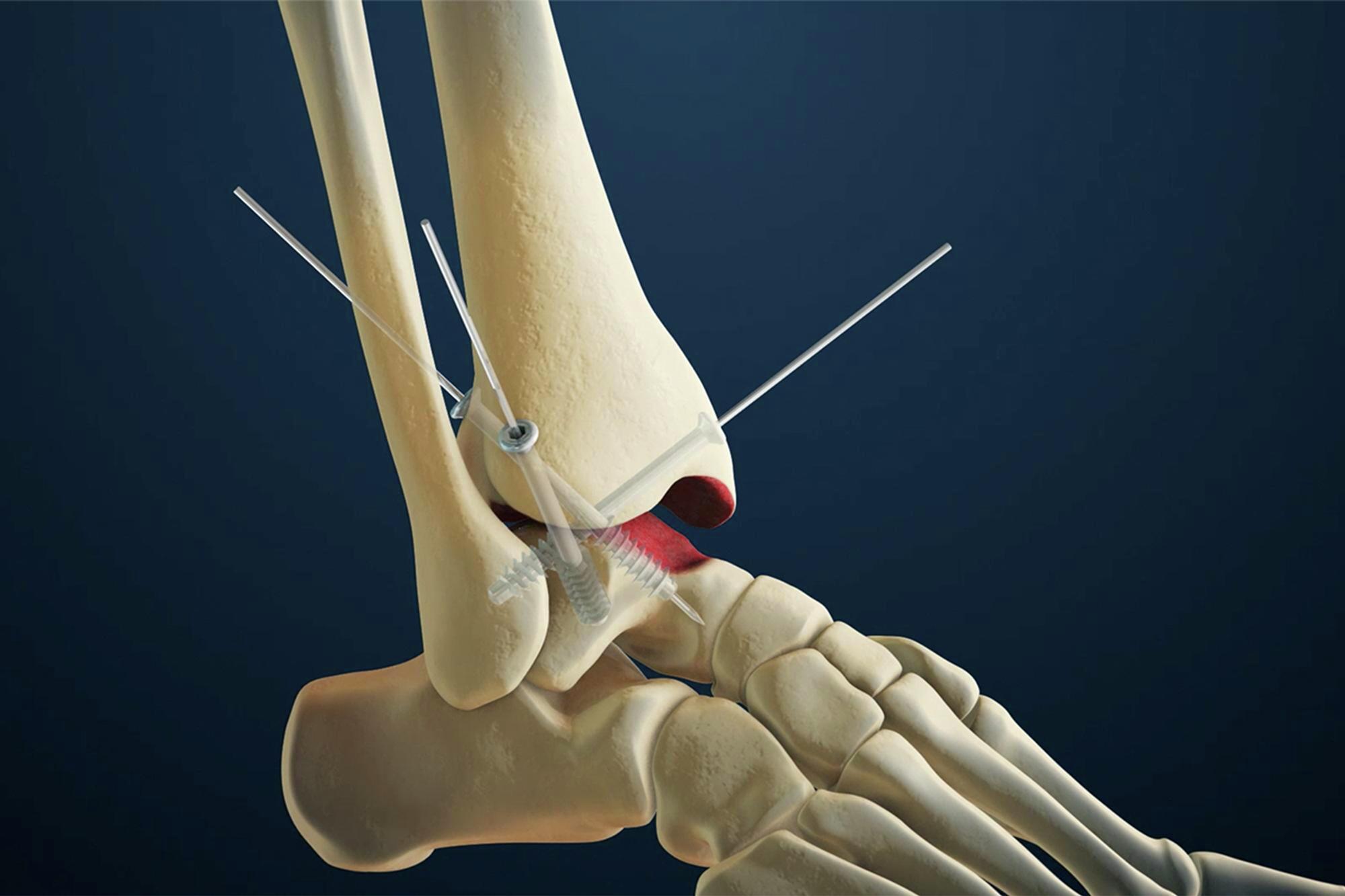 Ankle Arthritis Treatment, Diagnosis Foot and Ankle Surgeons