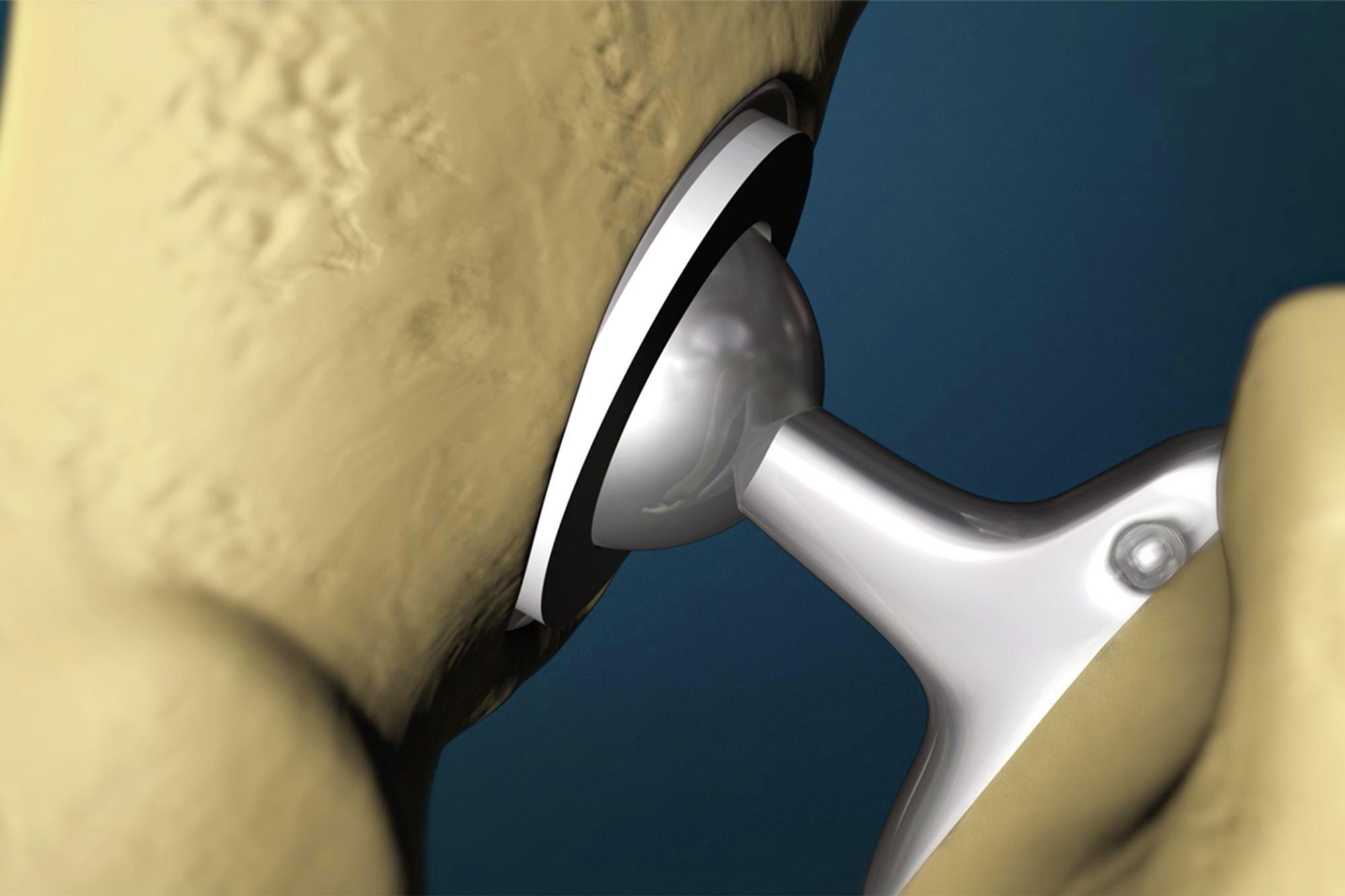 Hip Replacement Surgery Offered by Top Orthopedic Doctor in Baltimore