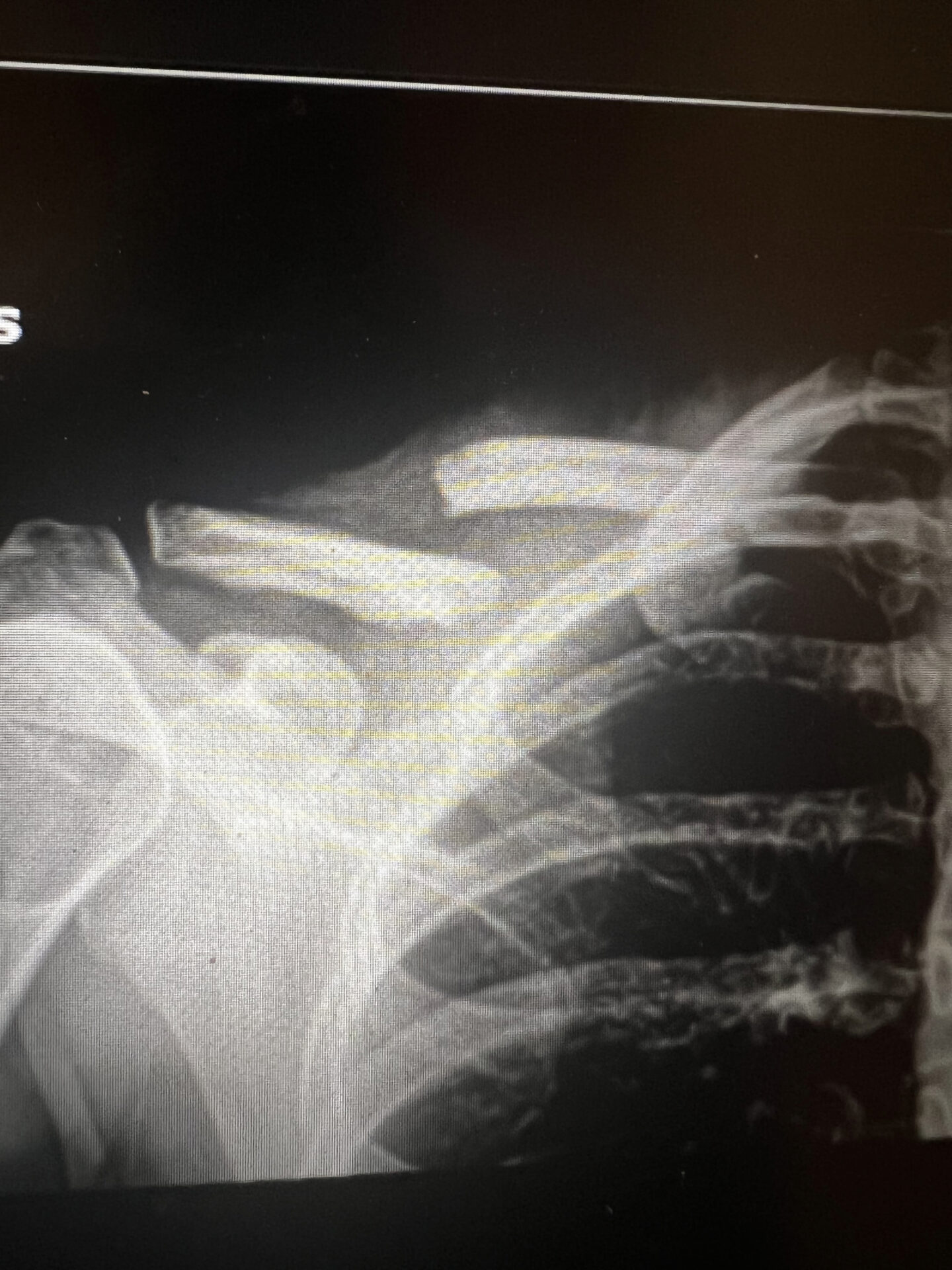 Your Questions, Answered Treating A Broken Collarbone Michigan
