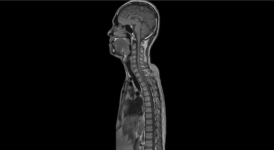 Spinal Cord Lesions & The Risk of Relapse MStranslate