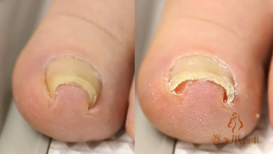 toenail separated from nail bed pictures, photos