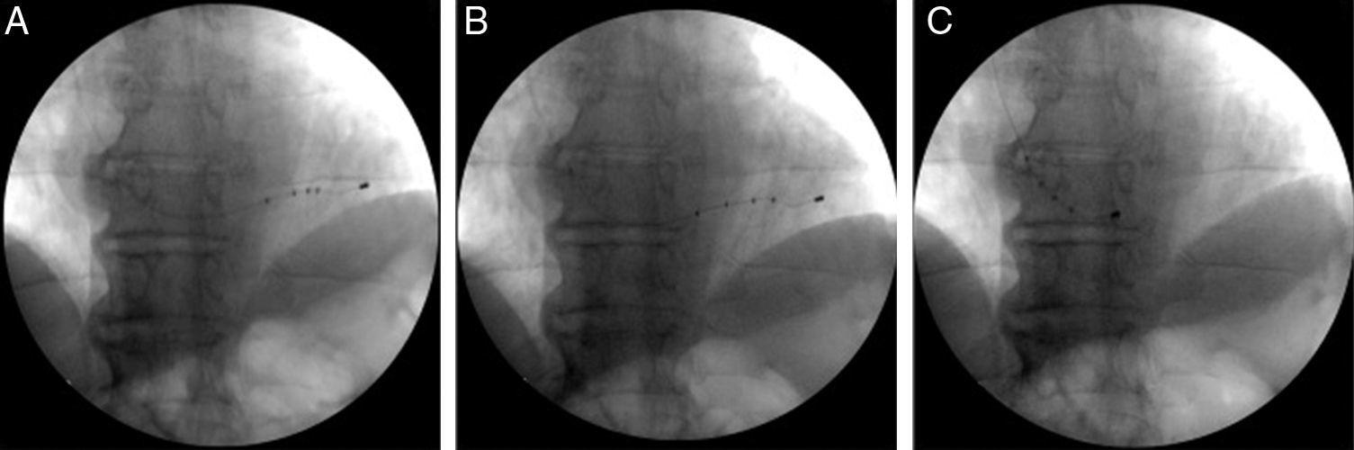 Active fixation coronary sinus lead extraction A safe procedure
