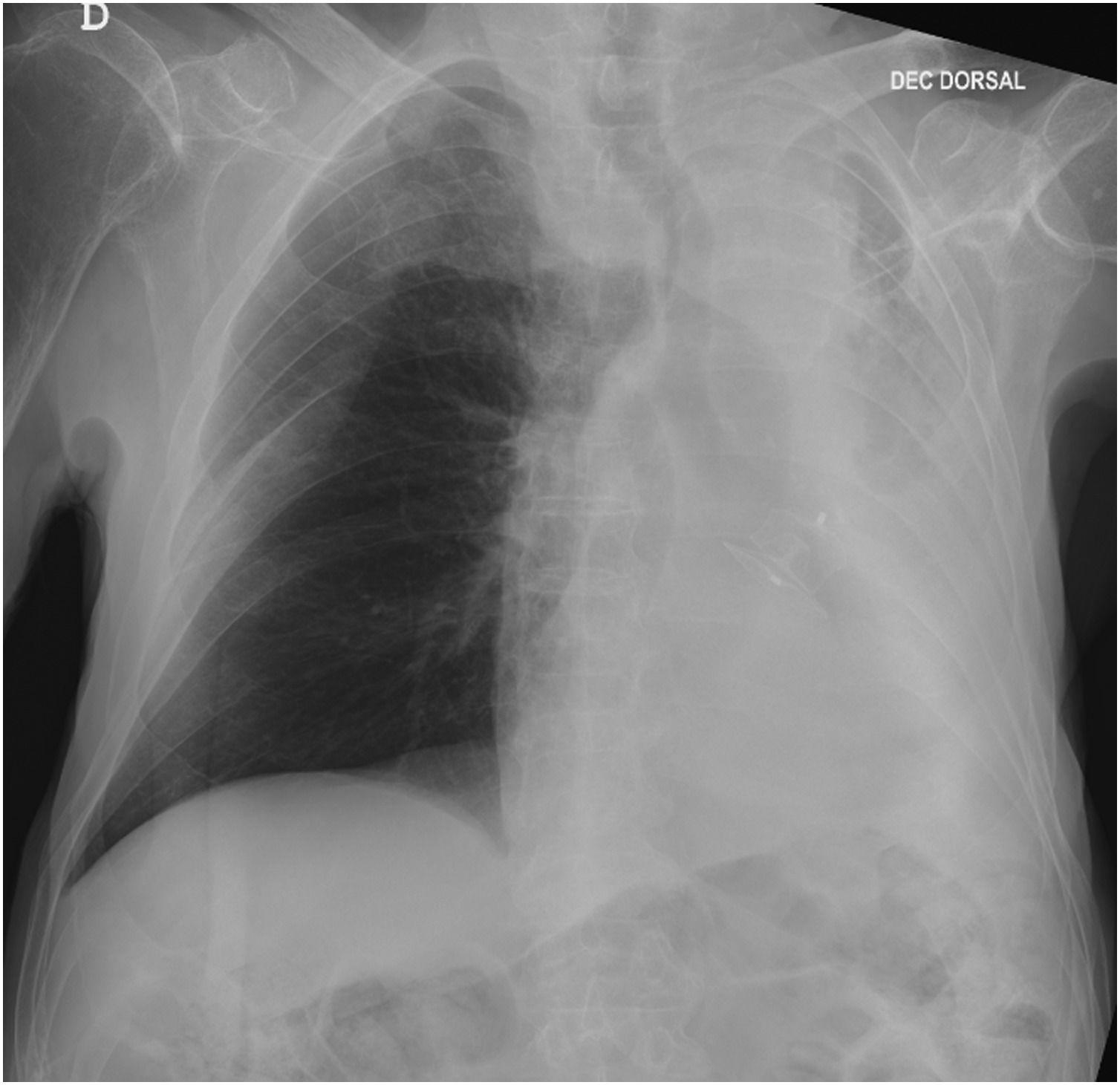 Is there a place for mechanical inexsufflator in the emergency