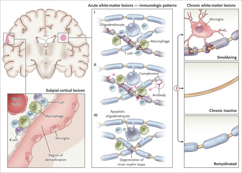 The central vein sign in MS Multiple Sclerosis Research Blog