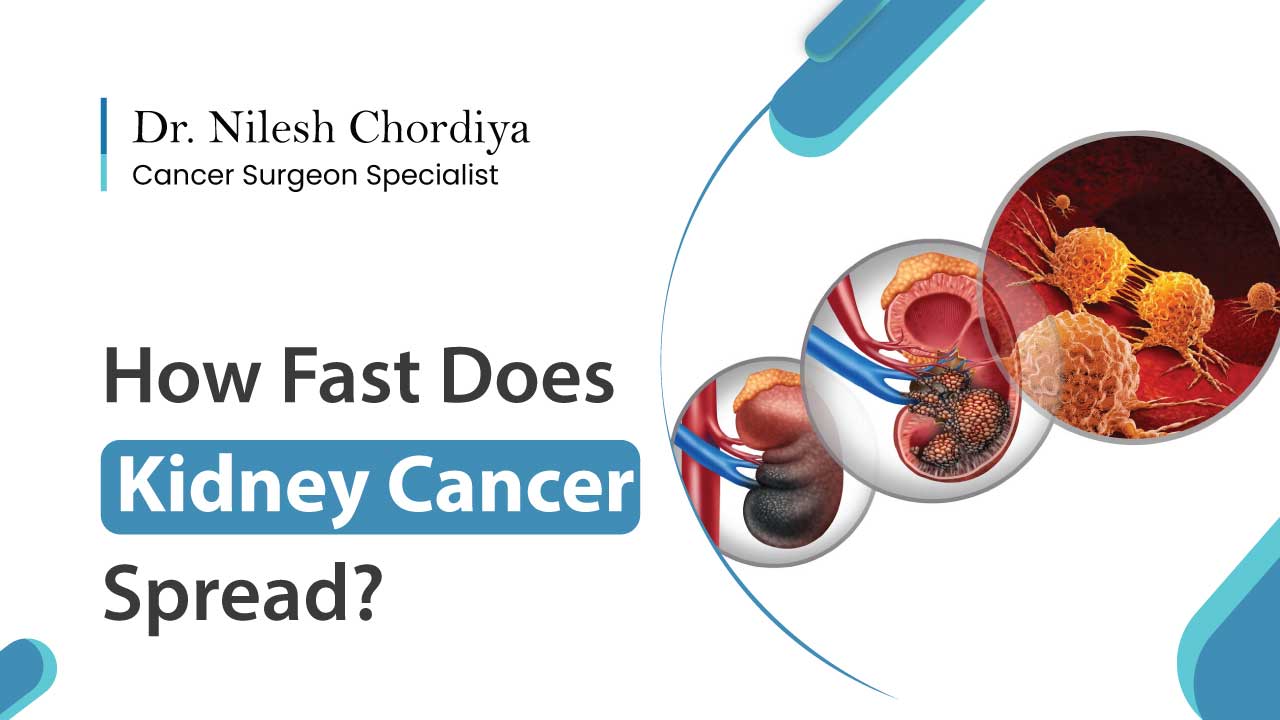 How Fast Does Kidney Cancer Spread? Dr Niles Chordiya