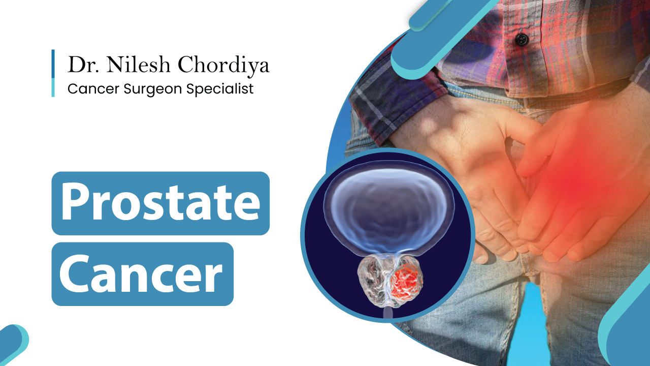 Stages And Treatments of Prostate Cancer Dr. Nilesh Chordiya