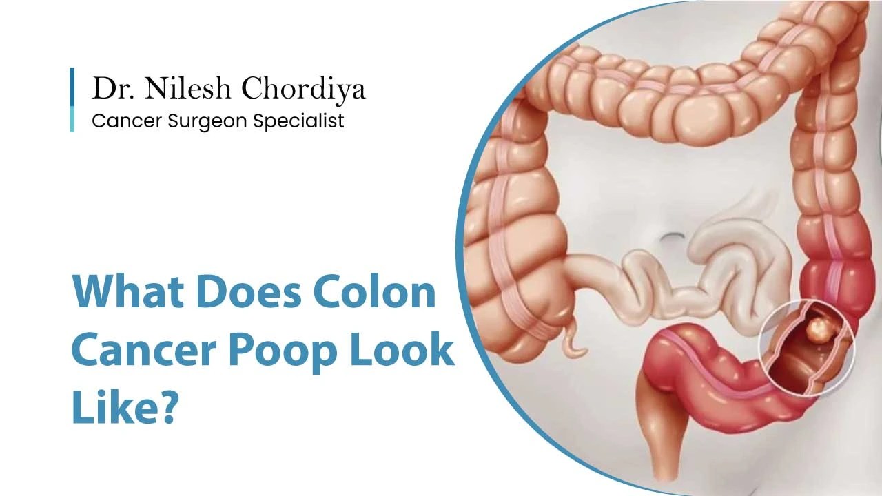 What Does Colon Cancer Poop Look Like?