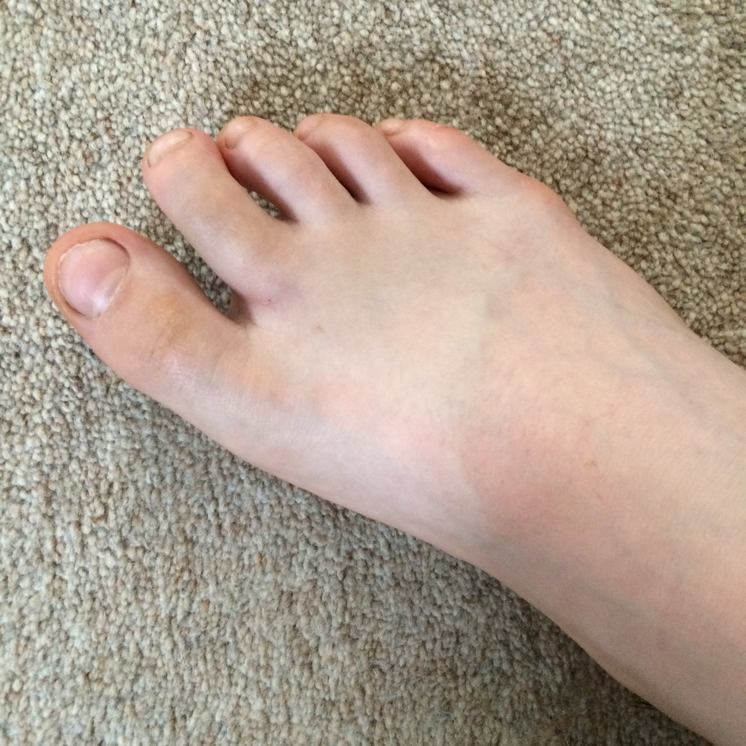 The broken toe and the drama performance Mum of Three World