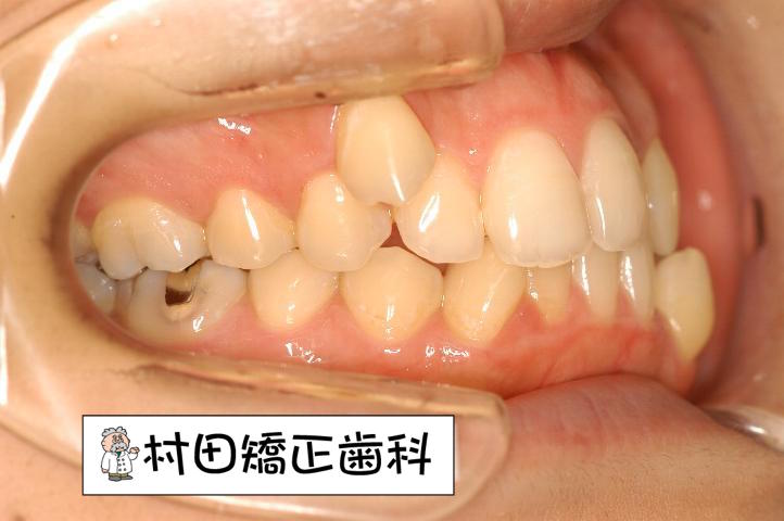 矯正治療可能な症状例 村田矯正歯科【豊橋市】