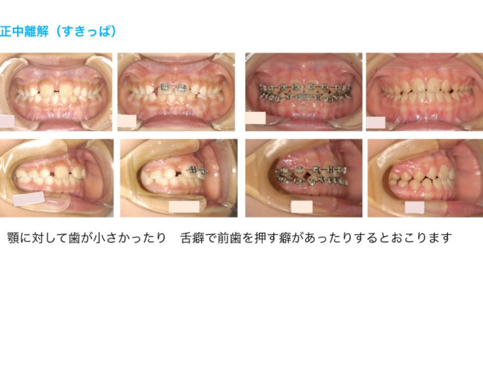 村田矯正歯科【豊橋市】 毎日矯正治療の患者様だけを診ている保険適用になる顎口腔機能診断料算定の指定医療機関です。