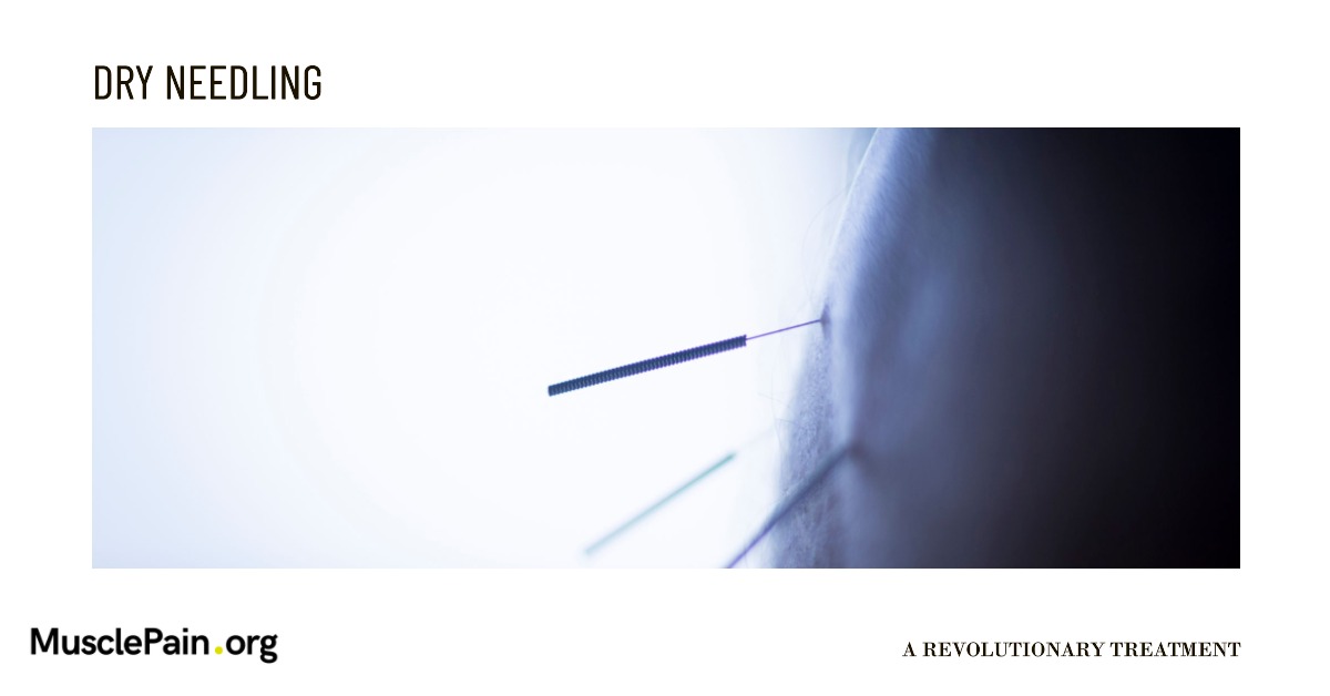 Dry Needling Muscle Pain