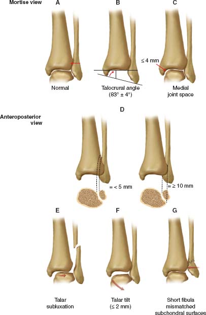 Injuries of the Ankle | Musculoskeletal Key