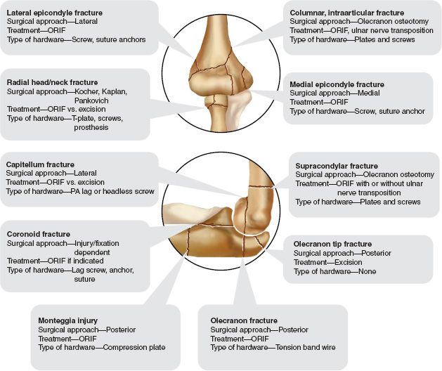 Fractures and Dislocations of the Elbow Musculoskeletal Key