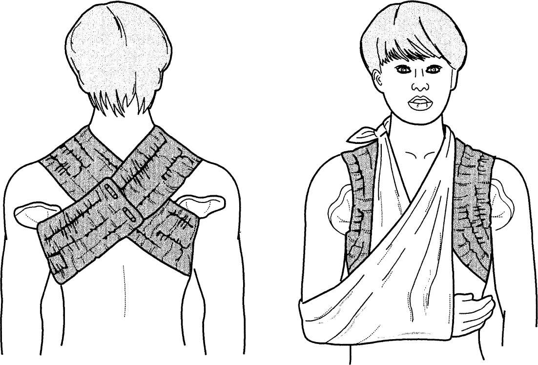 Common Types of Emergency Splints Musculoskeletal Key